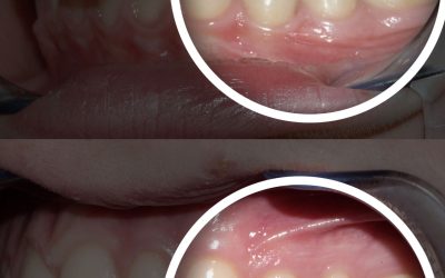 L&rsquo;orthodontie par aligneurs invisbles