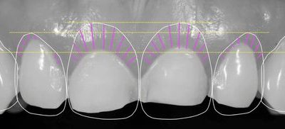 Le Digital Smile Design et la communication patient-praticien