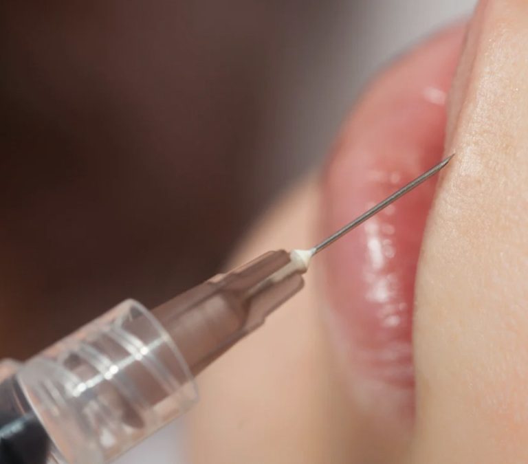 Injections d’acide hyaluronique autour du sourire : corriger les asymétries et revitaliser l’expression